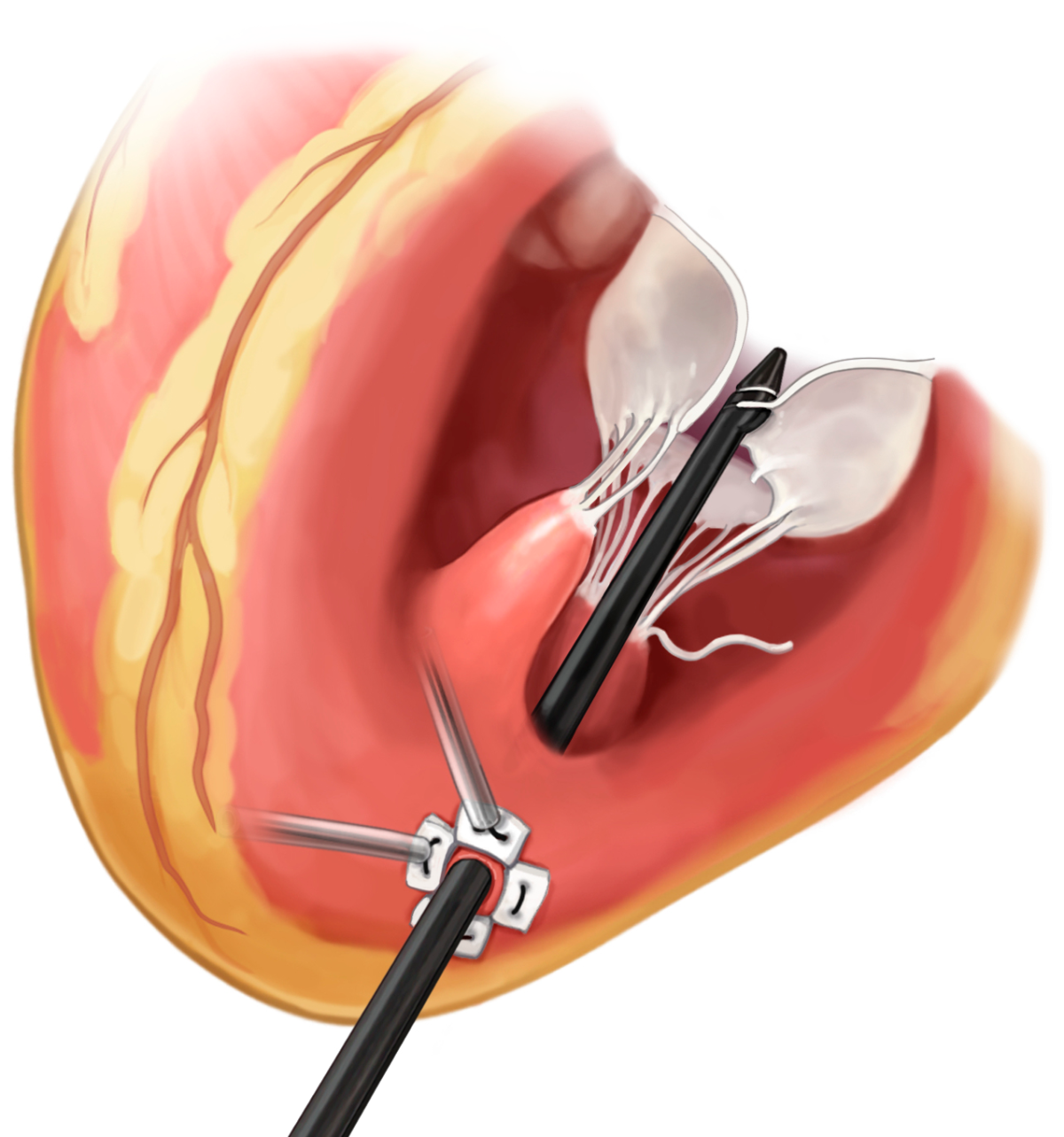 Patient Education Neochord